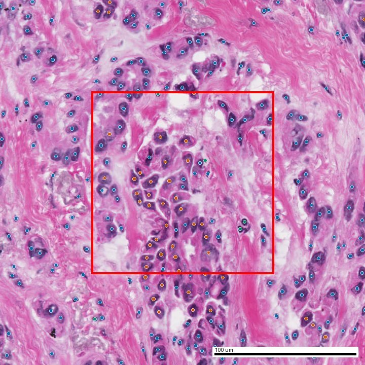 AI subtype evidence overlay on the same patch