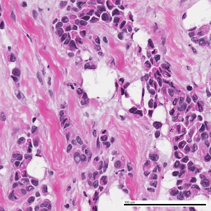 Illustrative H&E field used for necrosis analysis